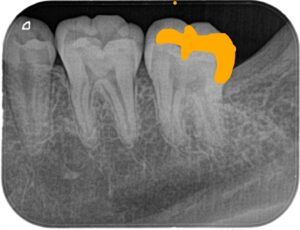 患者様の歯のレントゲン写真-その5