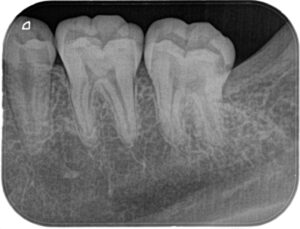 患者様の歯のレントゲン写真-その3