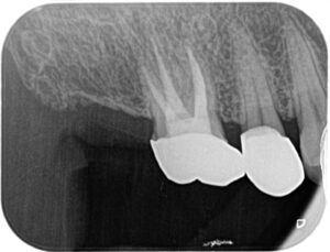 根管治療1年後の画像