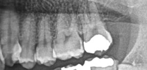 上顎左側第一大臼歯遠心のレントゲン写真