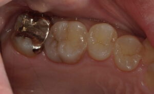 上顎左側第一大臼歯遠心の画像