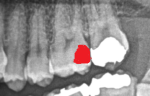 虫歯のレントゲン写真
