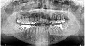 病変が確認できるレントゲン画像